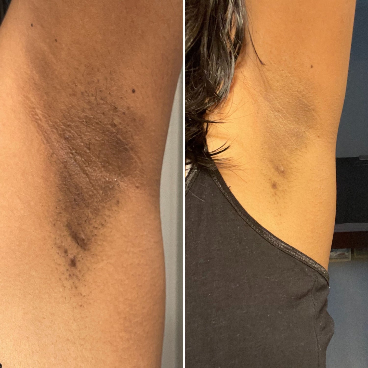 Before_and_After_Dark_Underarm_Treatment.jpg