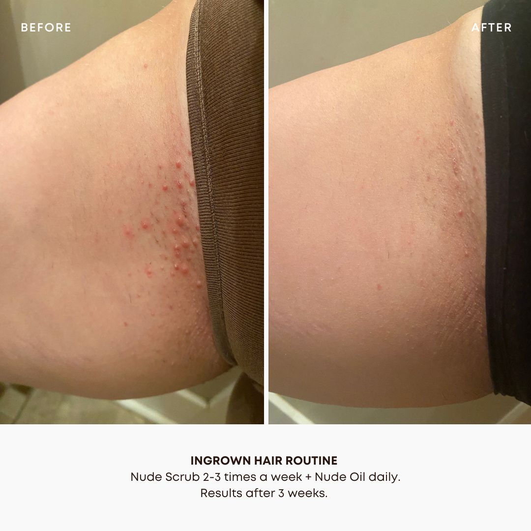 Ingrown Hair + Pre-Post Wax Oil