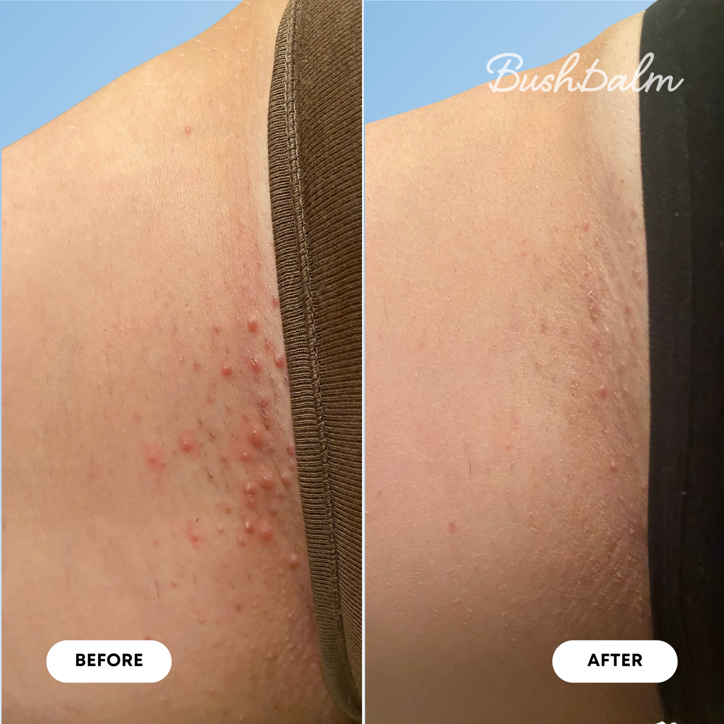 Ingrown Hair Pre/Post Wax Oil