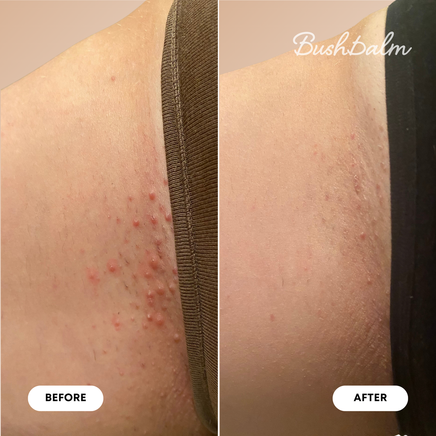Ingrown Hair Pre/Post Wax Oil