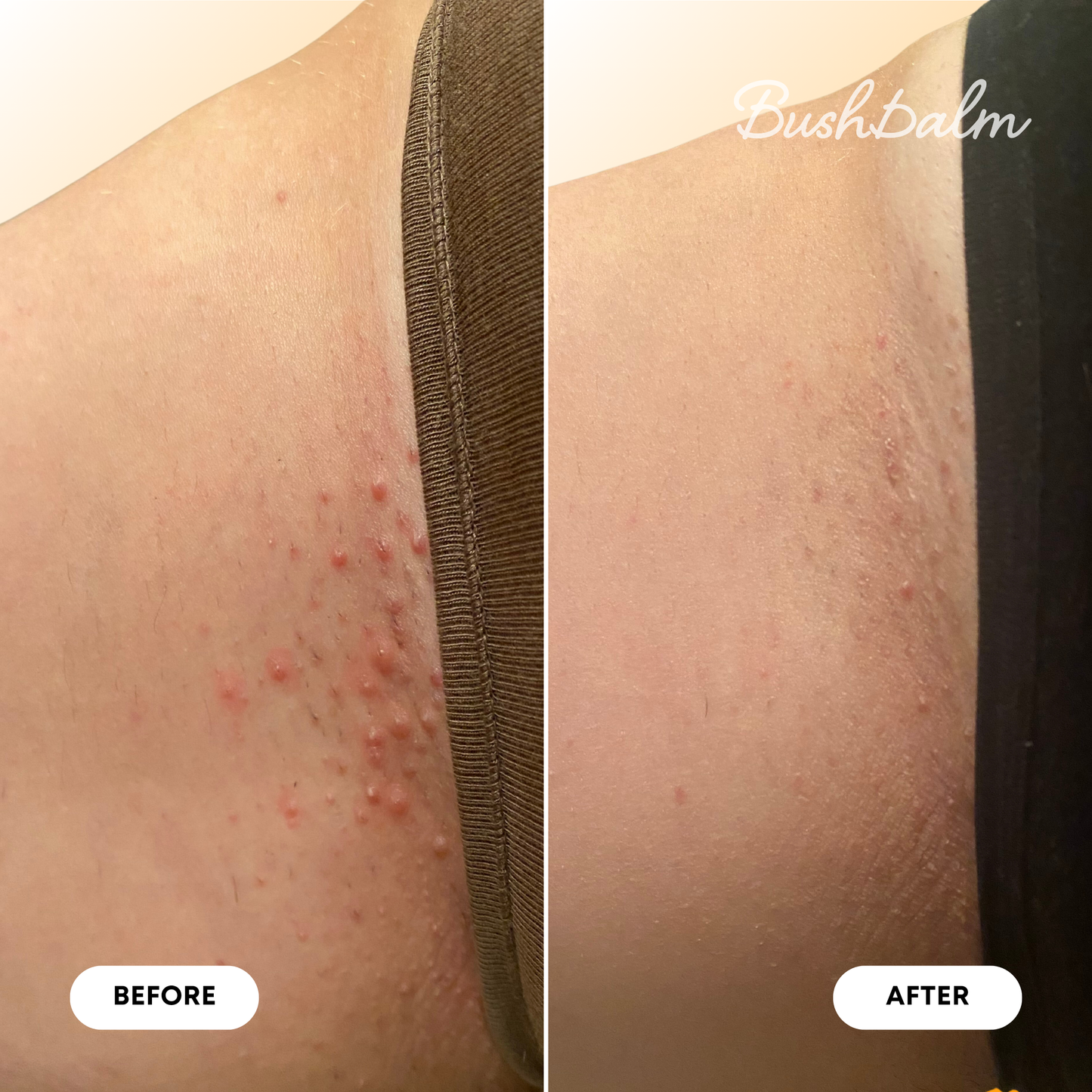 Mini Ingrown Hair Oil