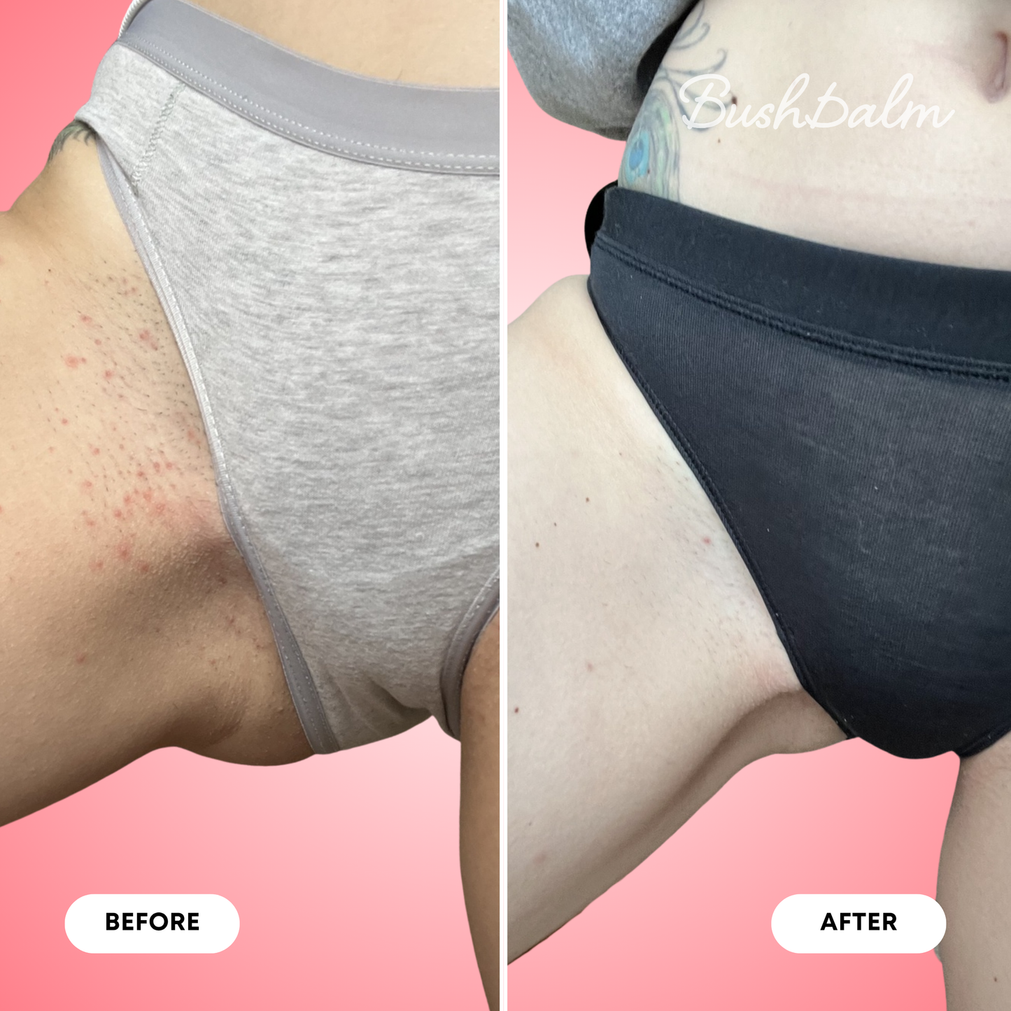 Ingrown Hair Exfoliating Body Scrub
