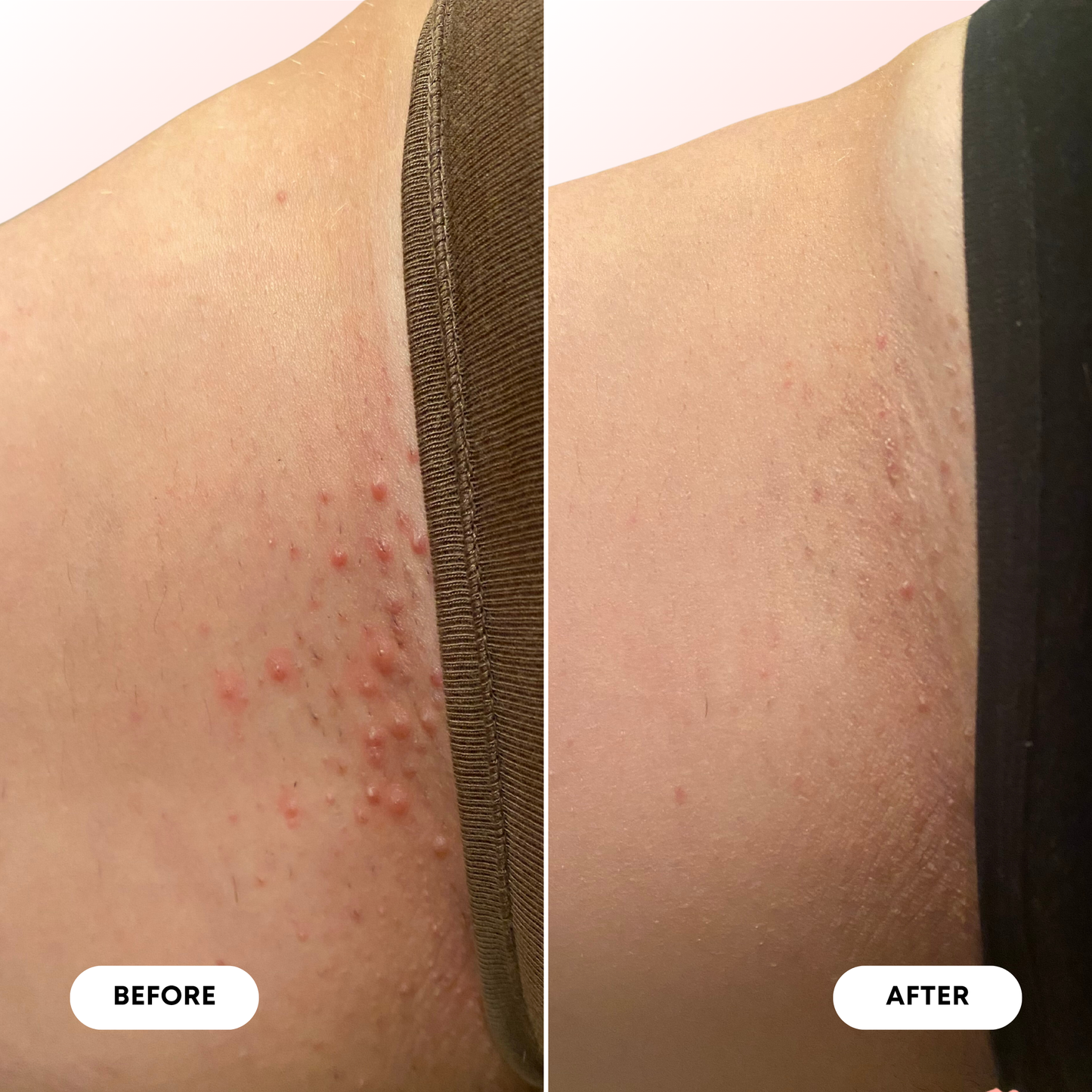 Ingrown Hair Pre/Post-Wax Oil