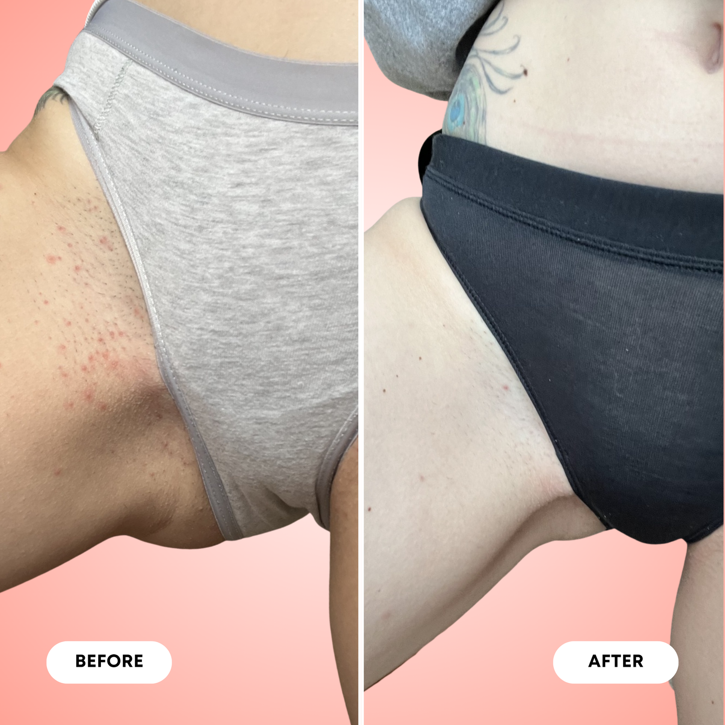 Ingrown Hair Exfoliating Body Scrub