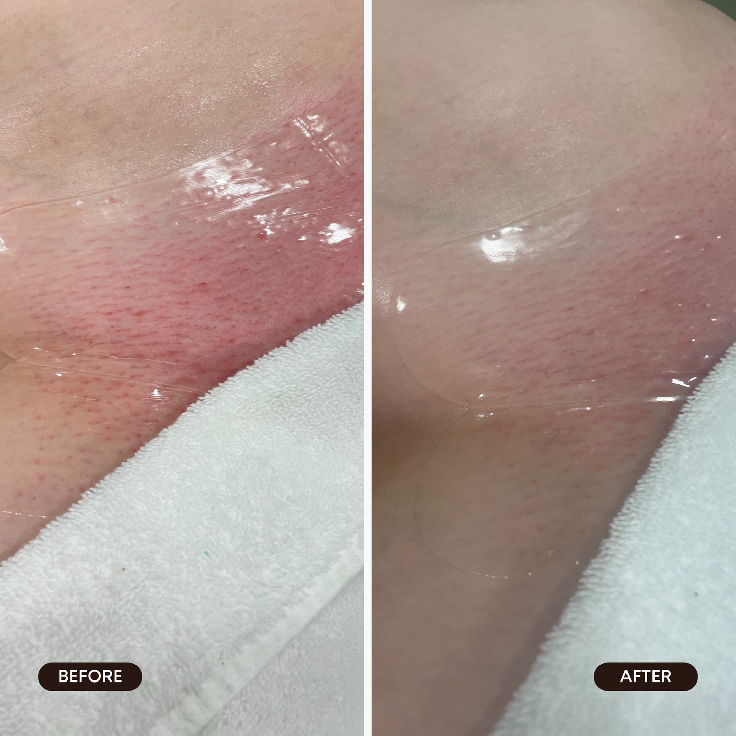 Hydrogel Vajacial Mask Set