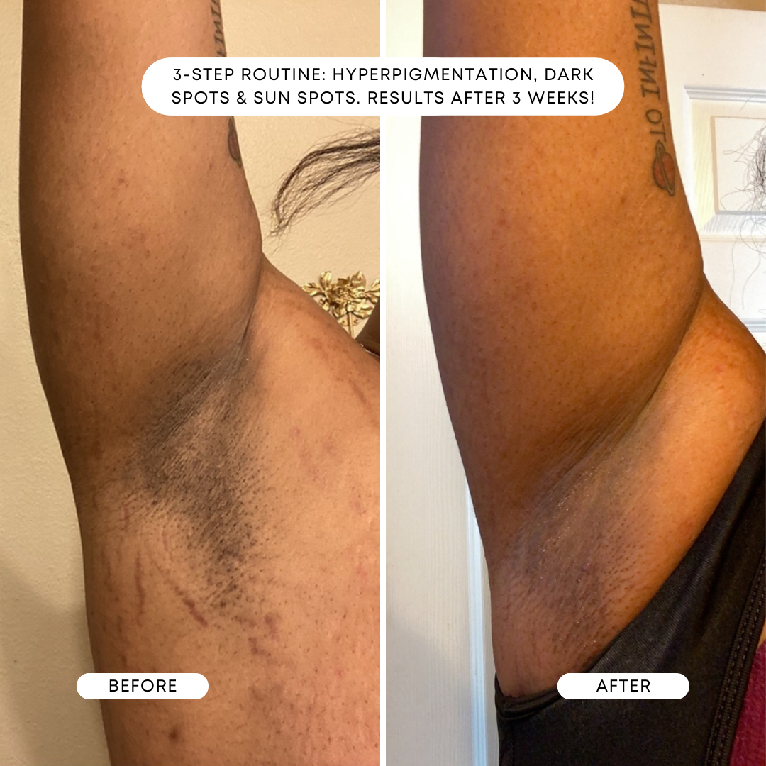 Dark Spot Before and After